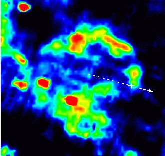 The inferred motion of the pulsar 
B1951+32 shown by the arrow and the supernova remnant CTB 80