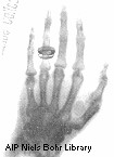 Röntgen’s X-rayed hand
